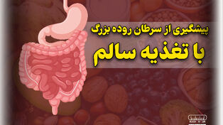 پادکست | پیشگیری از سرطان روده بزرگ با تغذیه سالم