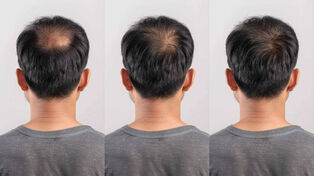 چرا گاهی درمان ریزش مو با بیشتر شدن ریزش شروع می شود؟