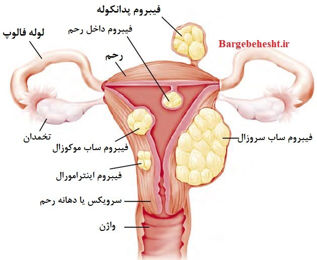 فیبروم رحمی چگونه درمان میشود؟ بررسی گزینههای دارویی، جراحی و آمبولیزاسیون